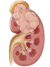 опухоль почки