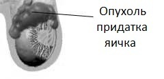 опухоль придатка яичка - рисунок