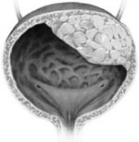 опухоль мочевого пузыря - рисунок