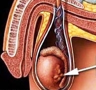 опухоль яичка - рисунок: семинома и рак