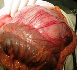 опухоль забрюшинного пространства