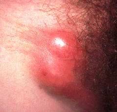 венерическая лимфогранулема - фото