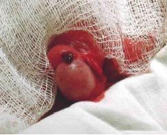 перекрут гидатиды