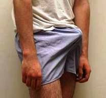 приапизм - фото