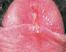 разрыв уздечки - фото