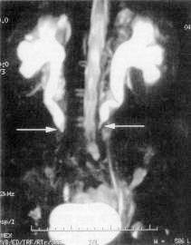 болезнь Ормонда - фото
