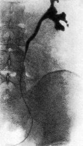 болезнь Ормонда - рентгенограмма