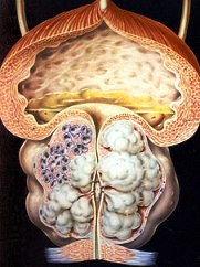 саркома простаты - рисунок
