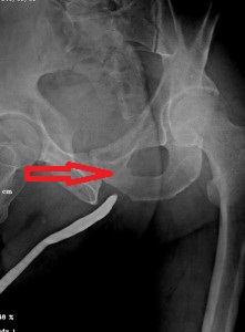 ретроградная уретрограмма склероза шейки мочевого пузыря