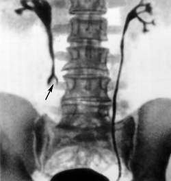 стриктура правого мочеточника - рентгенограмма