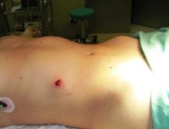 открытая травма почки