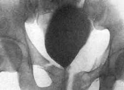 травма мочевого пузыря