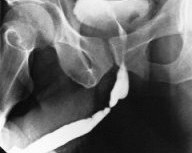 травма уретры - фото