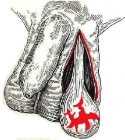 травма яичка - рисунок