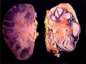 туберкулез почки - фото