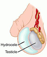 водянка яичка - гидроцеле - рисунок