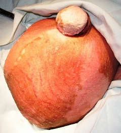 увеличена мошонка - фото