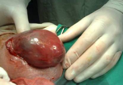 гематоцеле