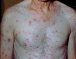 вторичный свежий сифилис - фото