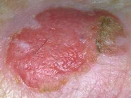 болезнь боуэна - фото