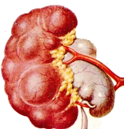 гидронефроз - фото