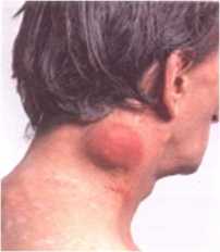 симптомы СПИДа - фотография