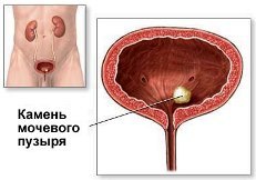 камень в мочевом пузыре - рисунок