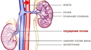 нефроптоз (опущение почки) - рисунок