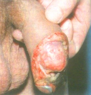 осложнения сифилиса - фото