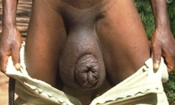 слоновость мошонки - фото