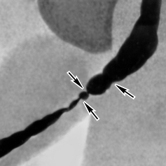 стриктура уретры - фото