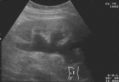 диагностика гидронефроза